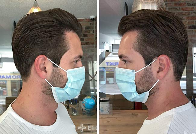 Before and After Donor Area Cagatay Side Profile