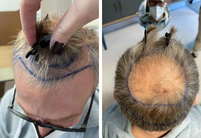 Raffaele Leucci before crown DHI hair transplantation 4750 grafts