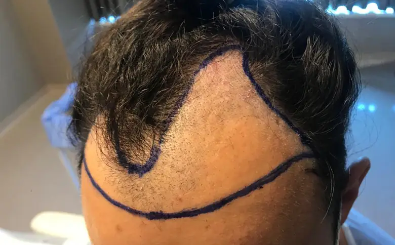 Hair Transplant Patient with new hairline drawn by Elithair