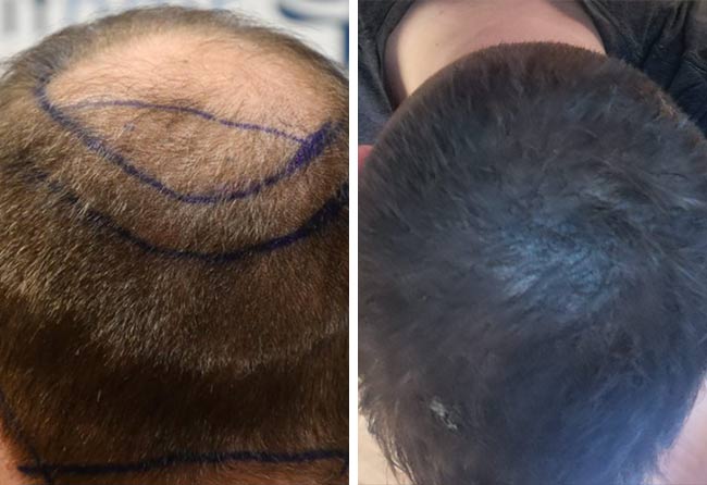 Patrick Bertram before and after sapphire hair transplantation 4700 grafts