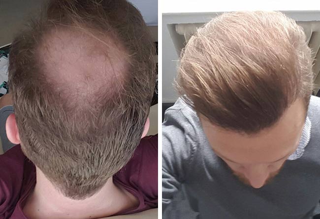 Stefan Heckmann before and after sapphire hair transplantation 3700 grafts