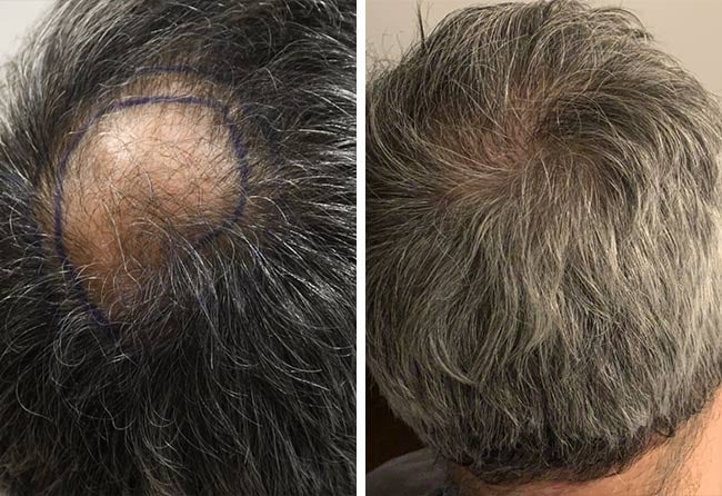 Ziad Ma before and after Sapphire hair transplantation 3000 grafts