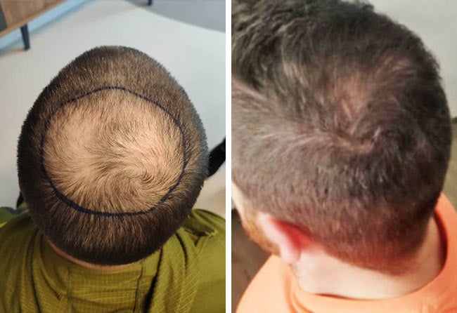 before after sapphire hair transplantation crown 4000 grafts Tho Marky