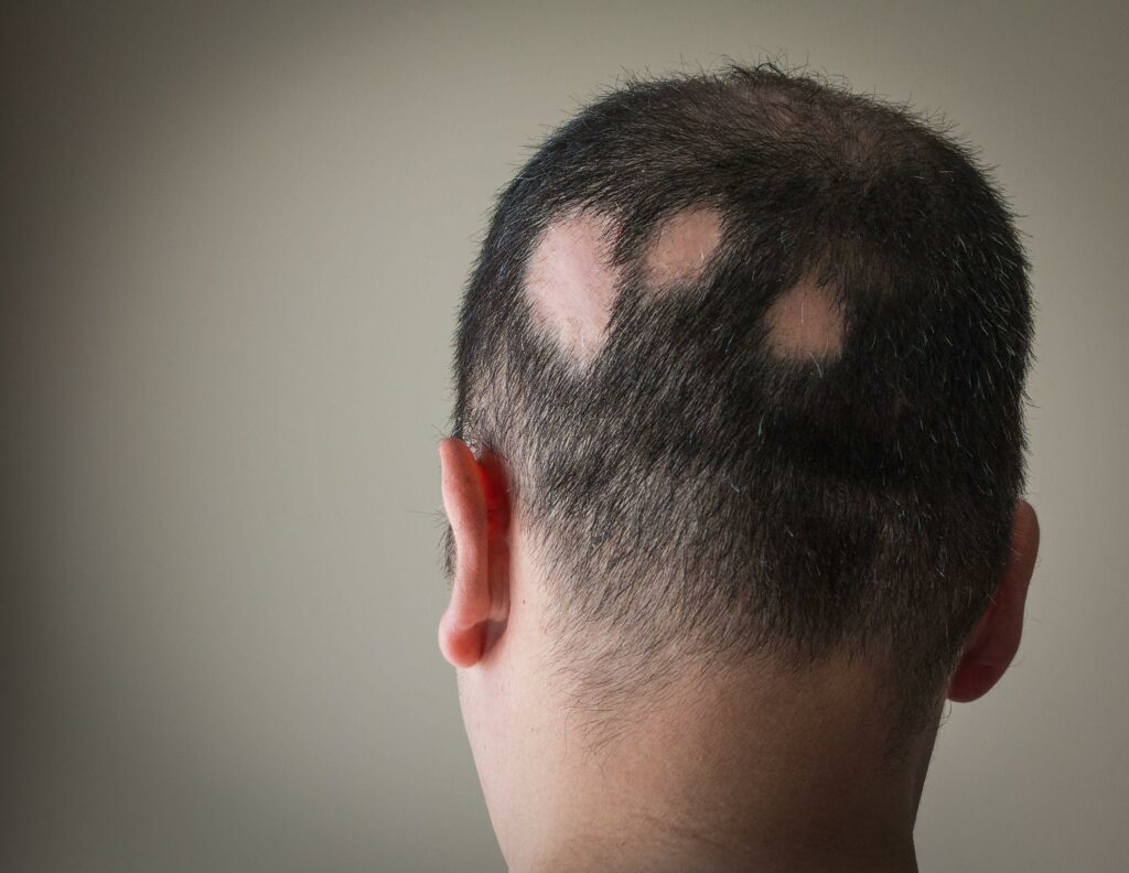 Circular hair loss on a man's head