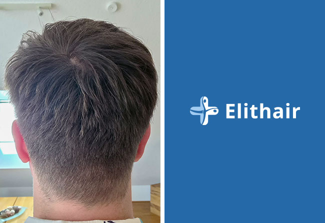 Donor area after 5.5 months patient Achim