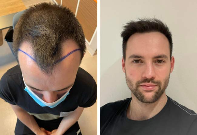 Picture Before after sapphire hair transplantation 2700 grafts Thorsten S.