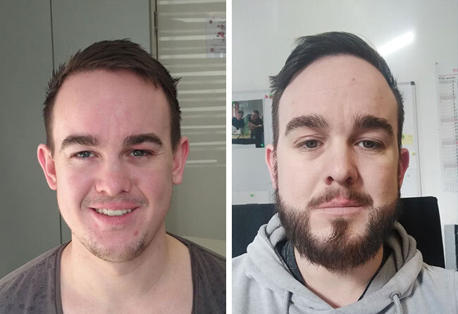 Before and after image of patient following beard transplant, showing off beard style