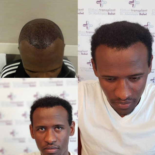 Before and after image of afro hair transplant