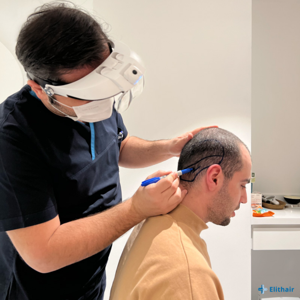 Drawing donor area on hair transplant patient