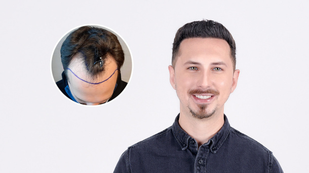 Image of patient showing before and after of hair transplant
