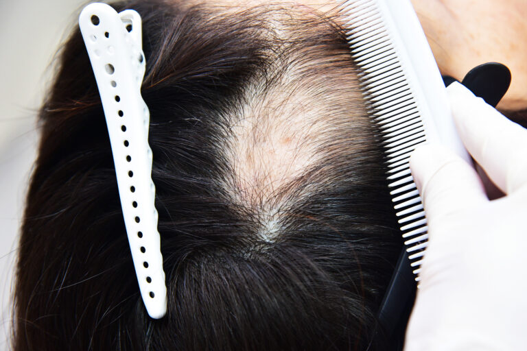 women-s-hair-thinning-4-reasons-treatments-elithair