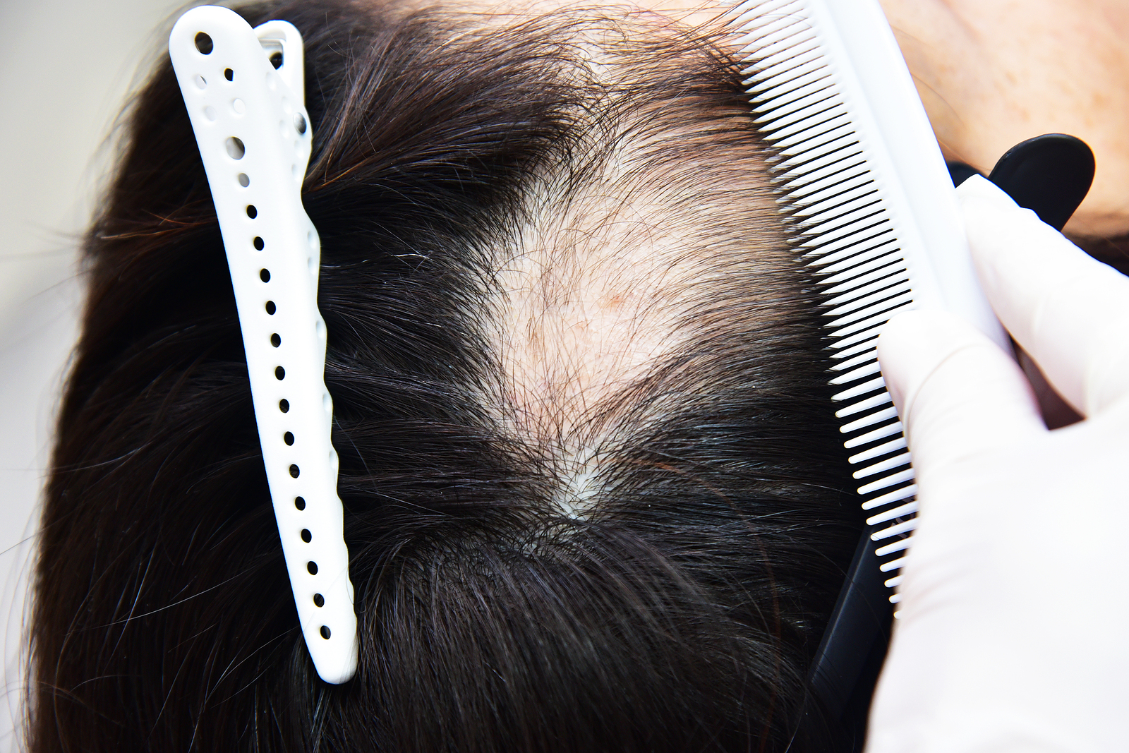 woman’s scalp showing hair shedding