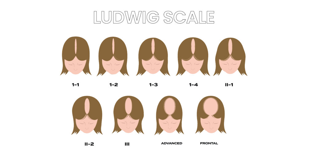 Diagram showing the variations in female pattern baldness according to the Ludwig hair loss scale