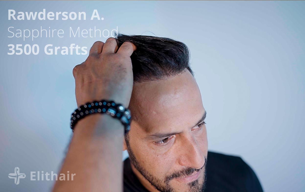 Patient Rawderson who had a positive hair transplant experience with Elithair showing his result