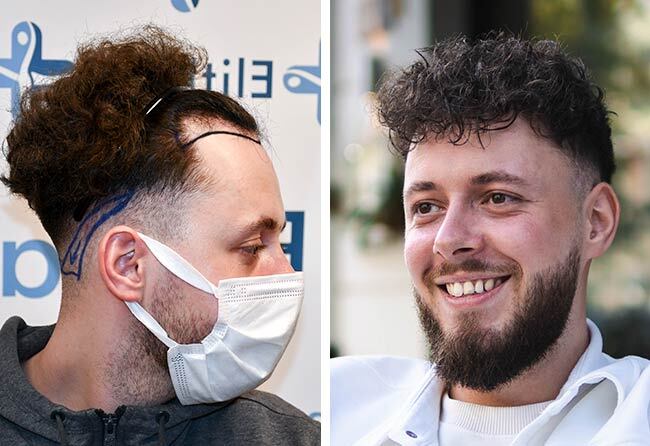 before after hair transplant pictures of Cilian W