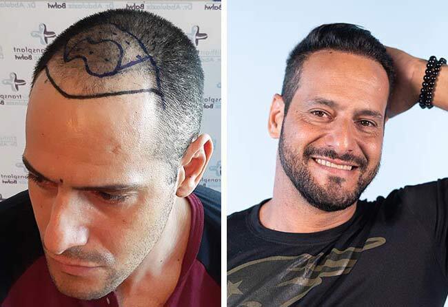 Picture before and after sapphire hair transplant 3500 grafts Rawderson Amaral
