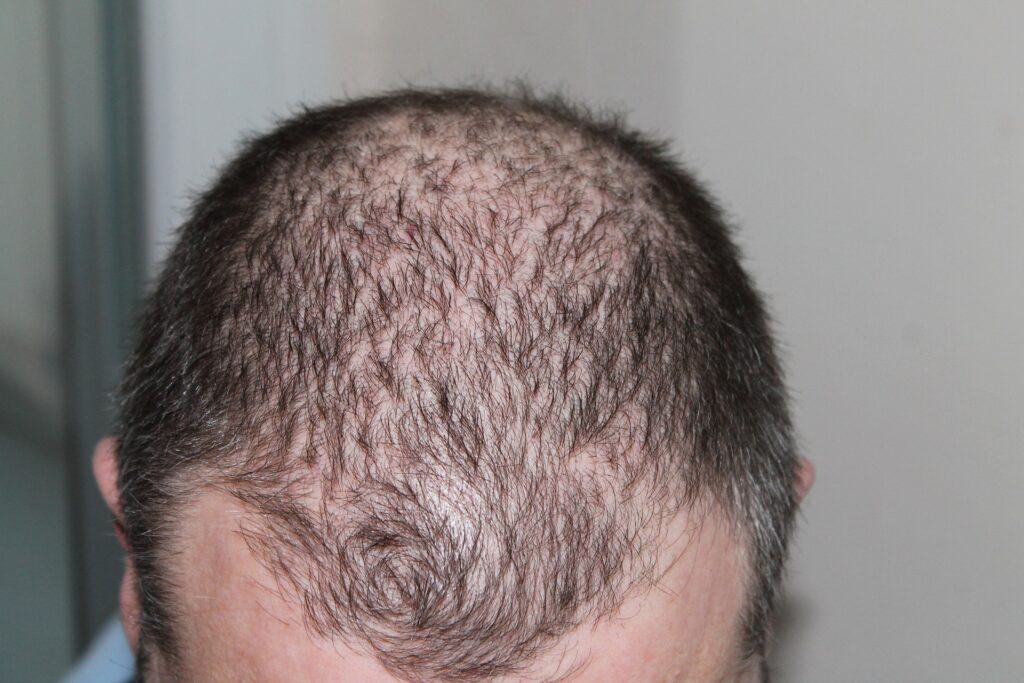 Does creatine cause hair loss balding male head