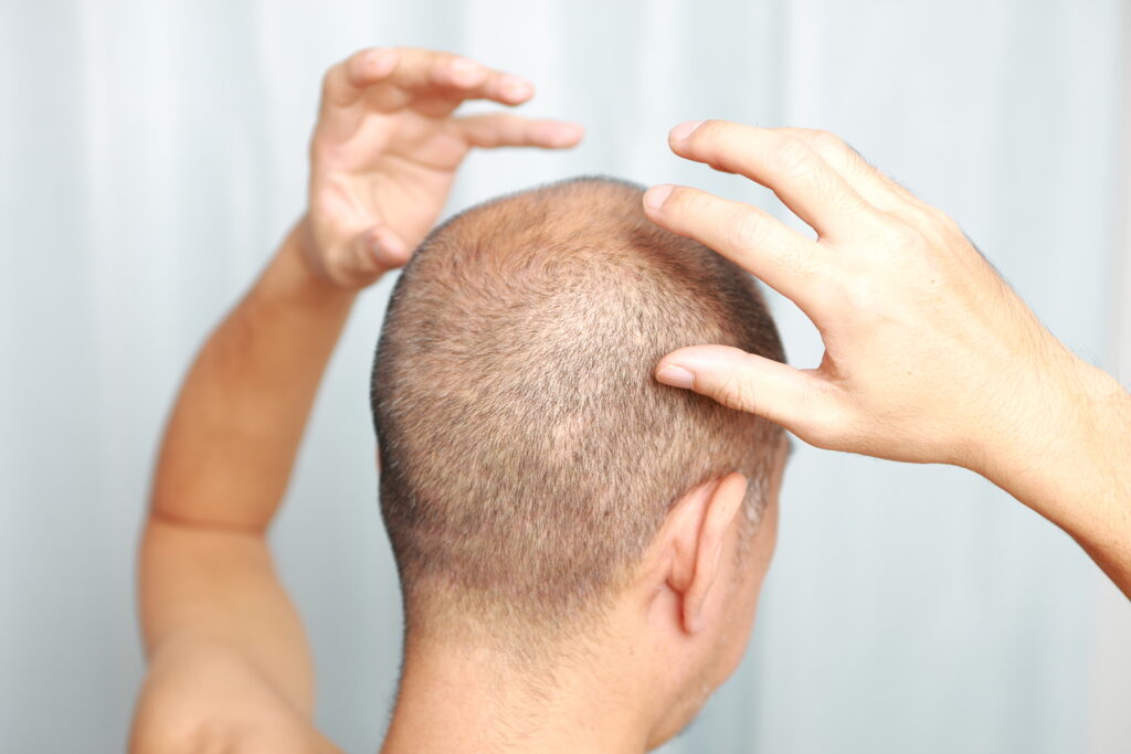 Back of mans head with hands over head checking for baldness