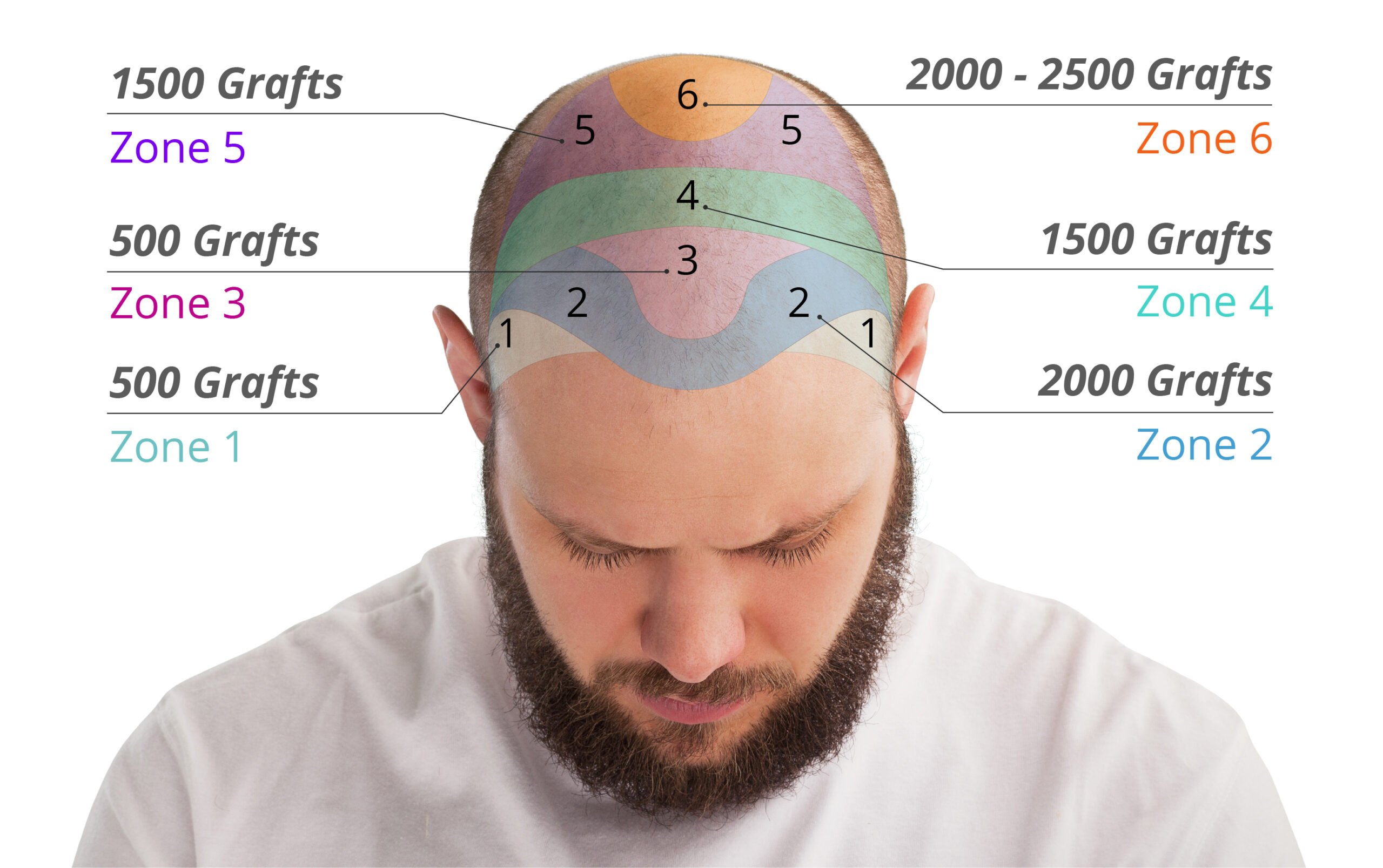 Comparative infographic with the number of grafts in the different areas of the head