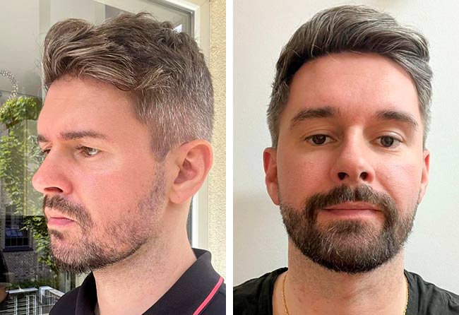 Before and after sapphire beard transplant 4250 Ismar S.
