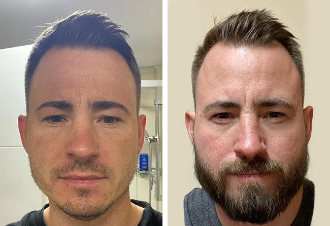 before and after sapphire beard transplant 4200 grafts steven a