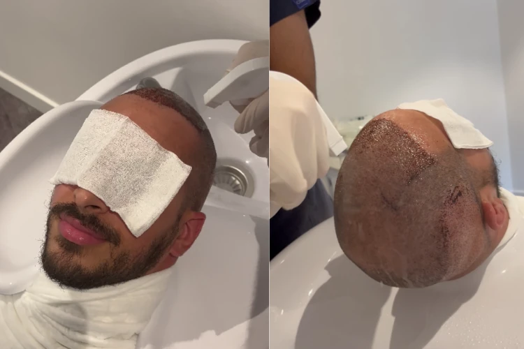 man is having his hair washed after a hair transplant