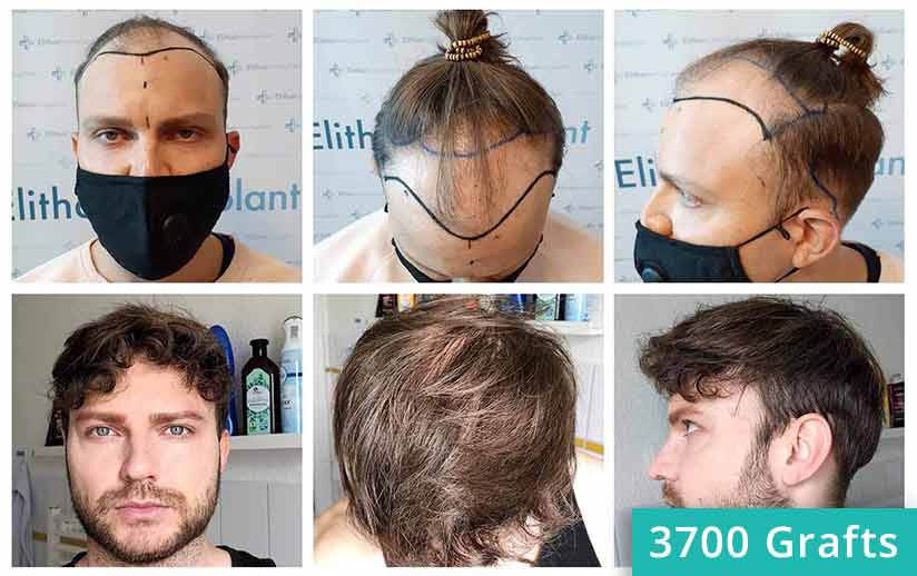 Picture before and after the hair transplant turkey of patient Eddie N.
