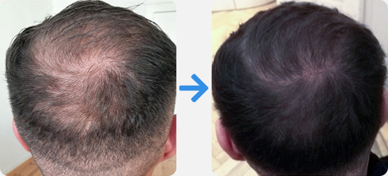 Before and after comparison pictures of a male patient with PRP hair treatment