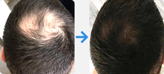 Before and after pictures for the PRP treatment from a male patient