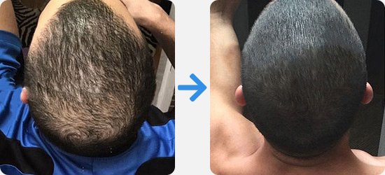 PRP hair treatment before and after pictures from a male patient
