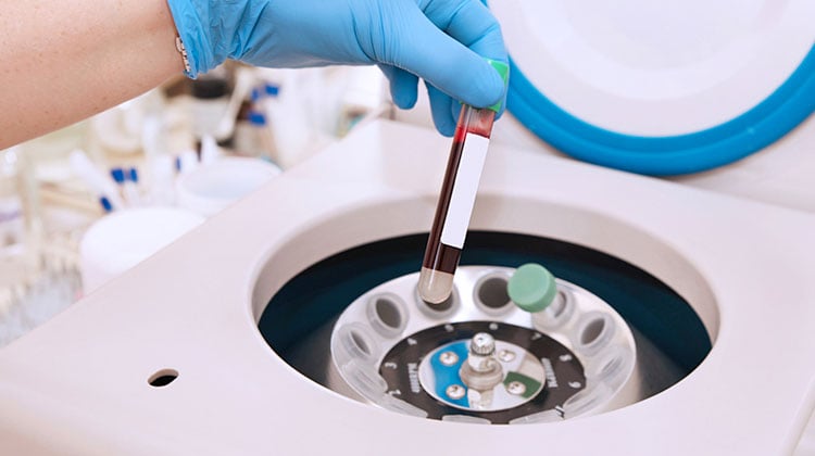 Blood getting centrifuged during the PRP hair treatment