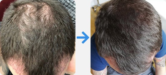 PRP hair treatment before and after comparison from a male patient