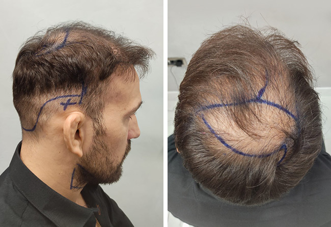 picture before dhi hair transplant max coga elithair turkey