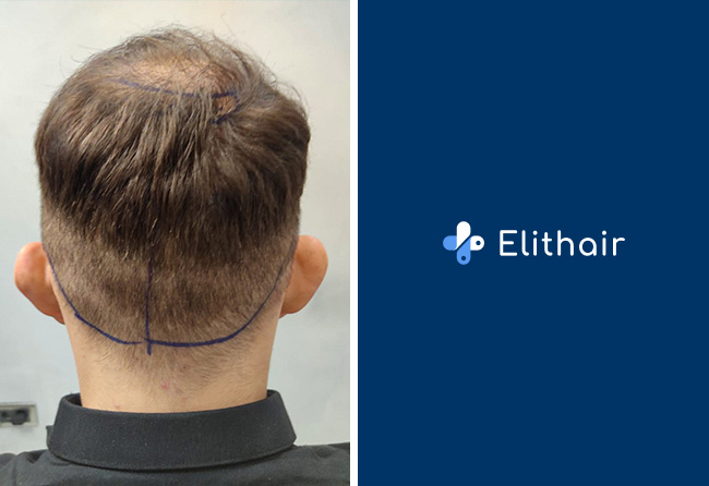 picture donor area max coga hair transplant before
