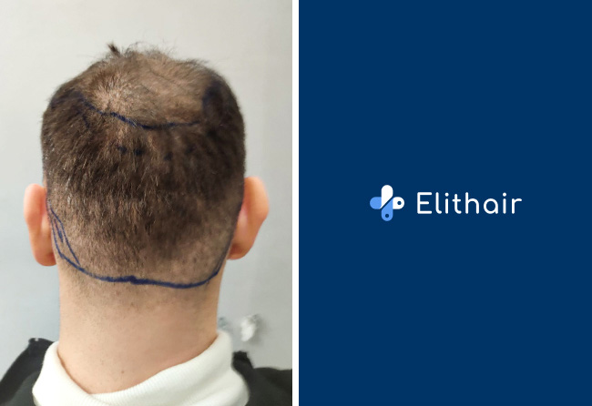 before picture of Elithair patient Kerim's donor area