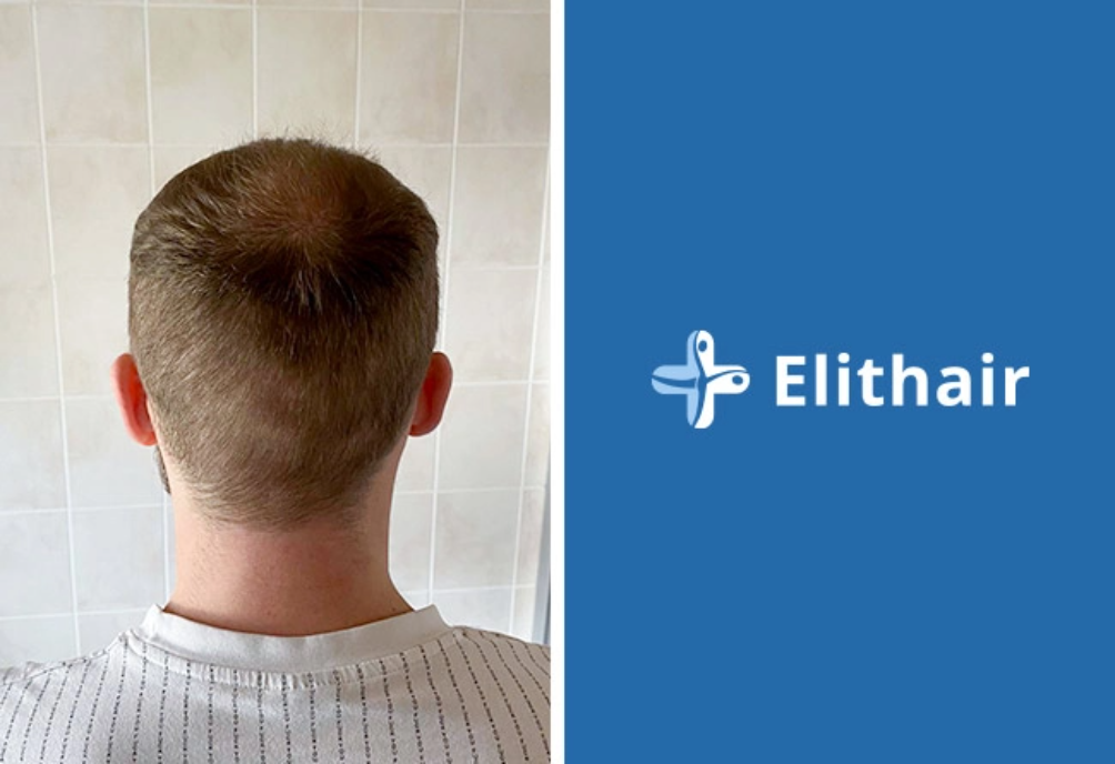 Donor Area from Elithair patient after the hair transplant