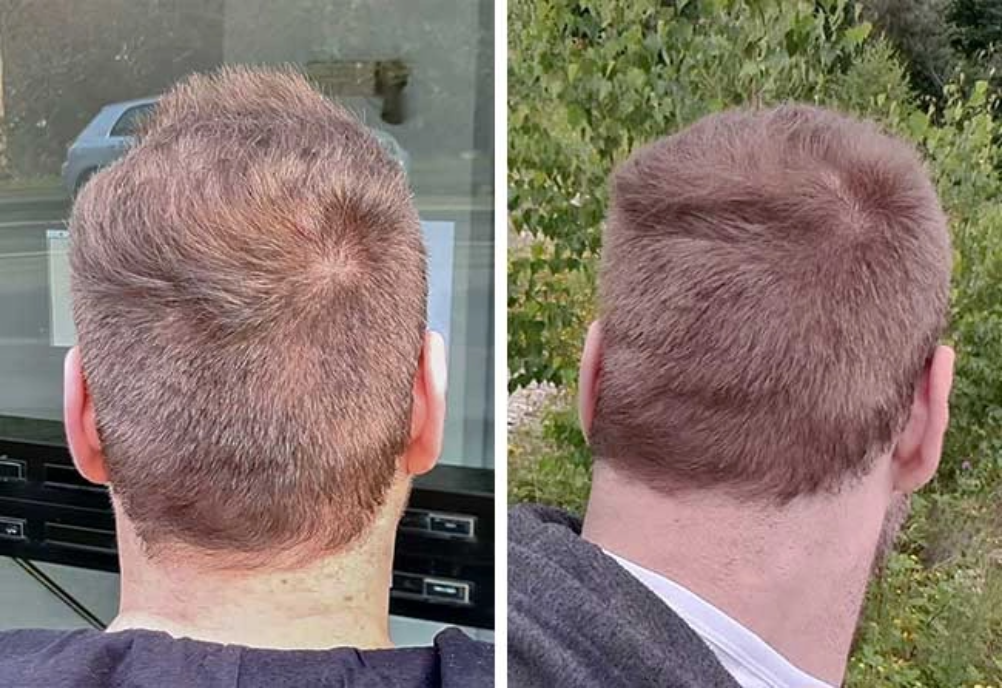 Donor area after hair transplant at elithair