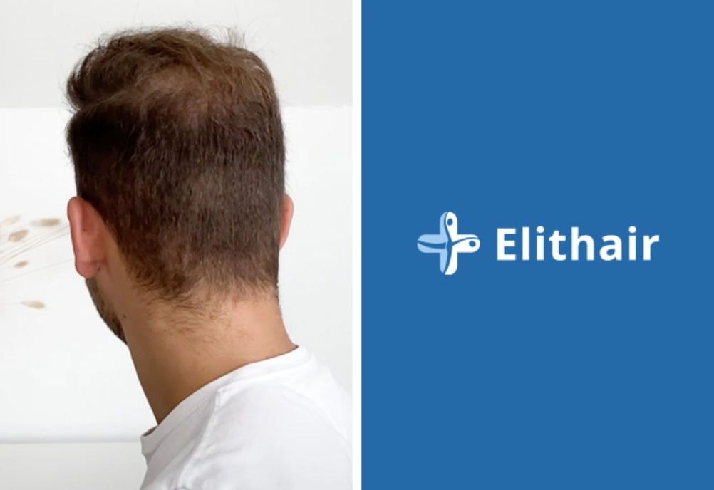 Patient shows his donor area after the hair transplant at elithair