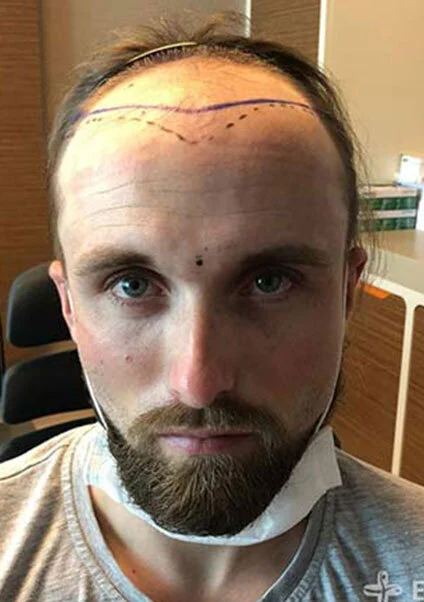 picture showing Frederik, an Elithair patient, before his hair transplant with Elithair