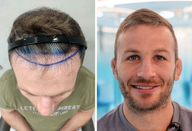 Before and after picture of the DHI hair transplant with 5700 grafts of Stephan Pütz.