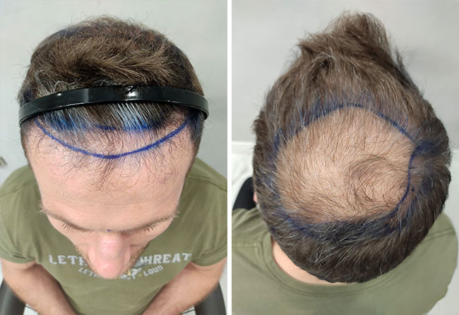 Before DHI hair transplantation with 5700 grafts of Stephan Pütz