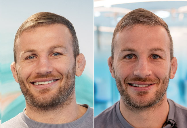 Result of the DHI hair transplant with 5700 grafts of Stephan Pütz.