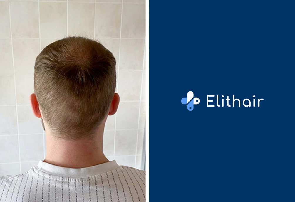Donor Area from Elithair patient after the hair transplant