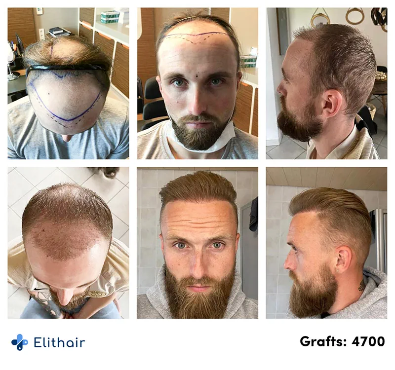 Pictures of the before and after hair surgery results with 4700 grafts for Elithair's patient Frederik
