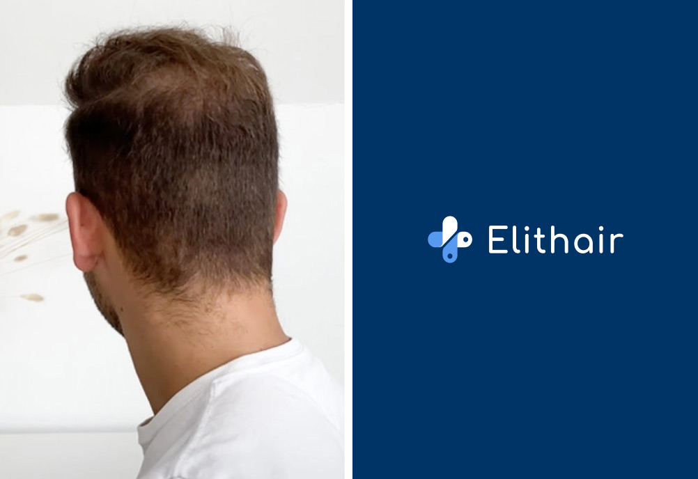Patient shows his donor area after his hair surgery at elithair