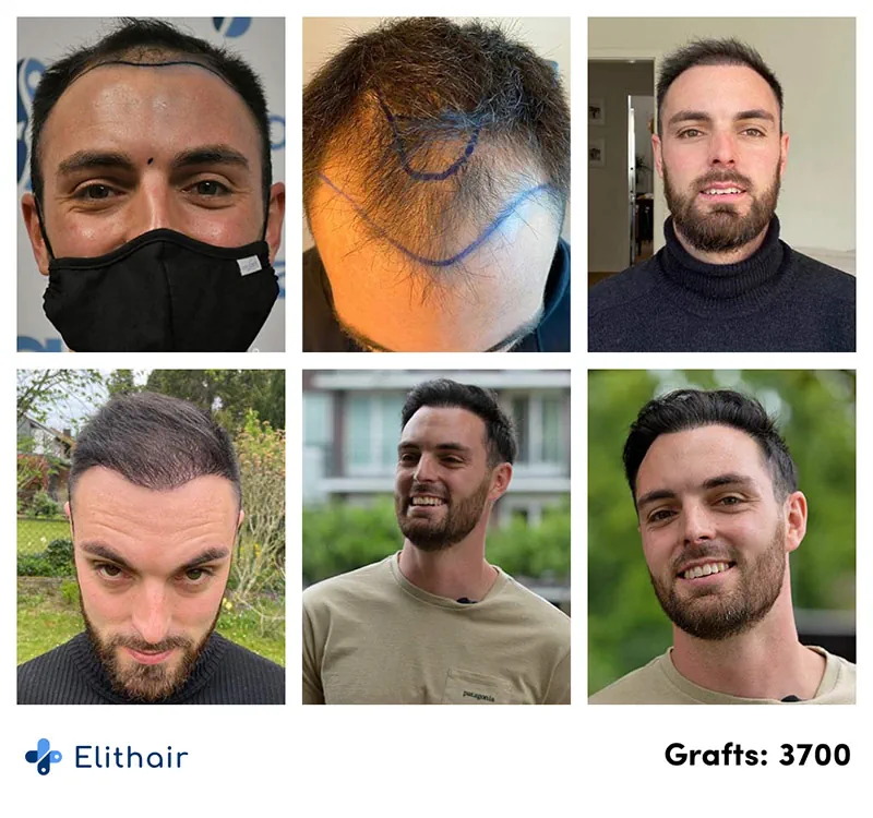 Pictures of the before and after hair surgery results with 3700 grafts for Elithair's patient Sebastian