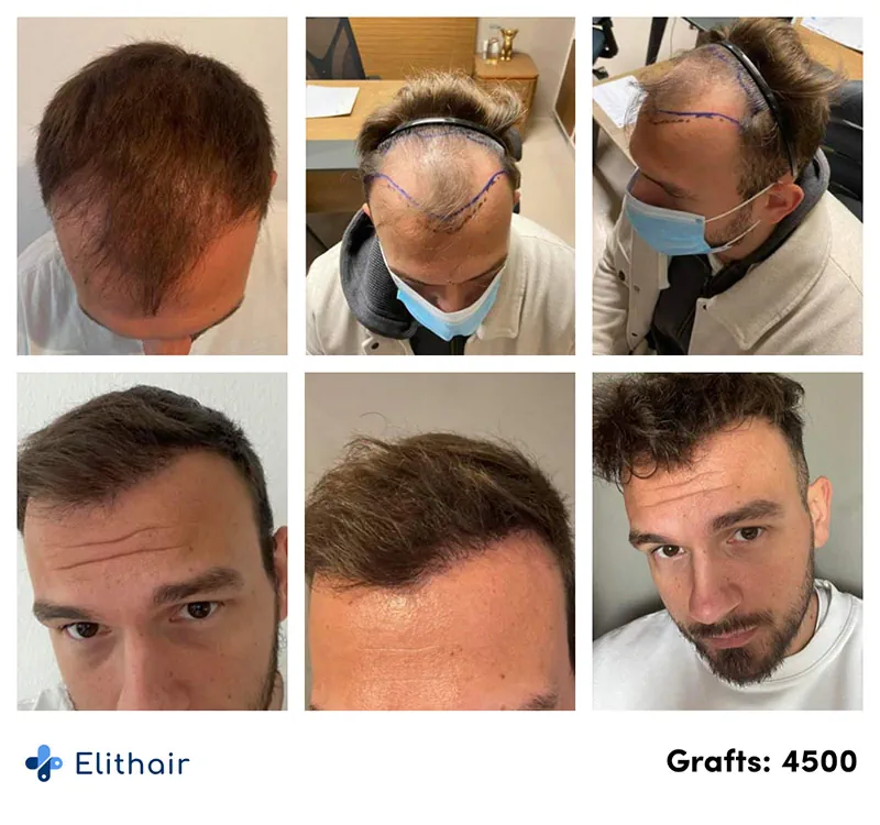 Pictures of the before and after hair surgery results with 4500 grafts for Elithair's patient Sefket