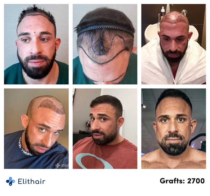 Thumbnail picture before and after the percutaneous hair transplant with 2700 grafts of Kevin