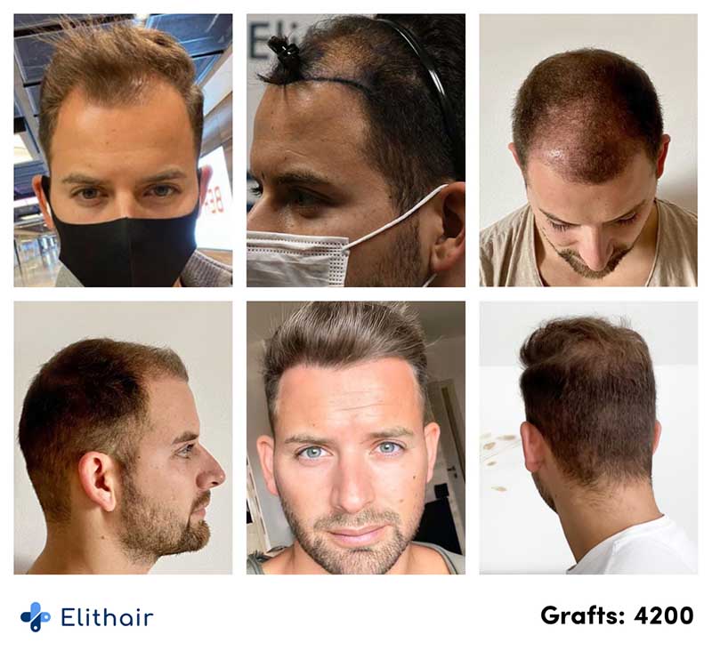 Thumbnail picture before and after the percutaneous hair transplant with 4200 grafts of Marcel