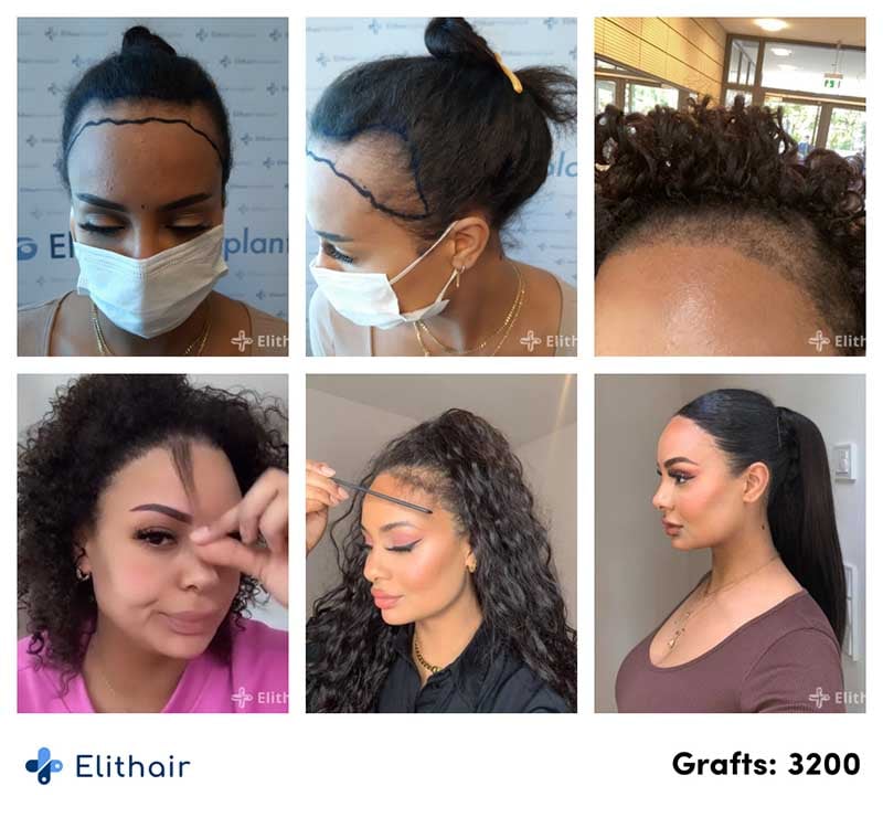 Thumbnail picture before and after the hair transplant for woman with 3200 grafts of Jahy, an Elithair patient